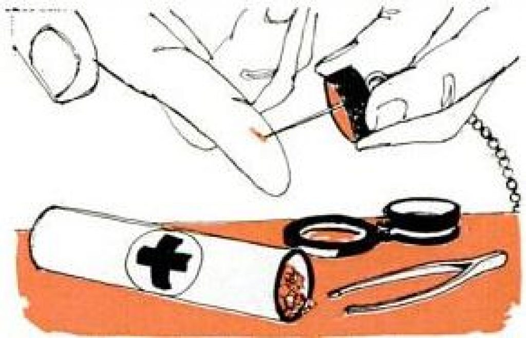 splinter-remover-kit splinter removal kit